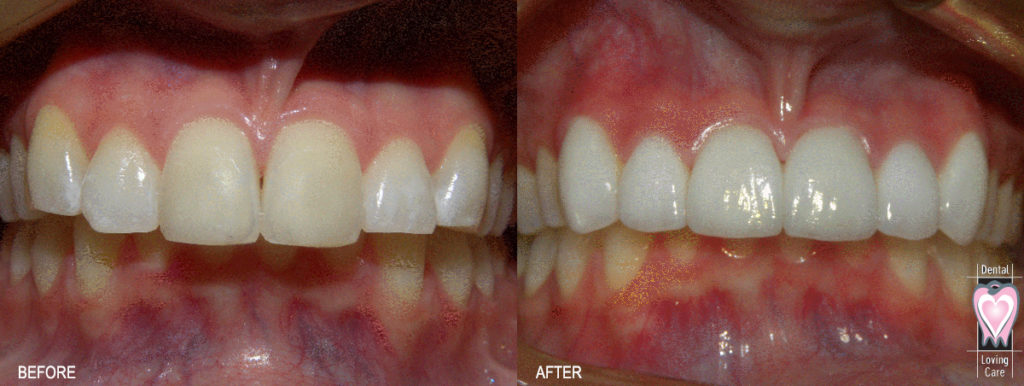 dental-loving-care_before-after02_bn